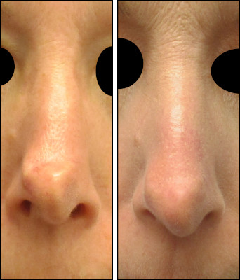 rhinoplasty